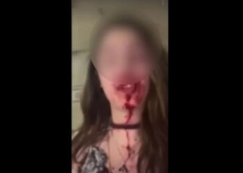 Άμφισσα: Κατήγγειλε με αίματα στο πρόσωπο ότι την ξυλοκόπησε ο σύζυγός της -«Θα σε βρει ο πατέρας σου στον κάδο»