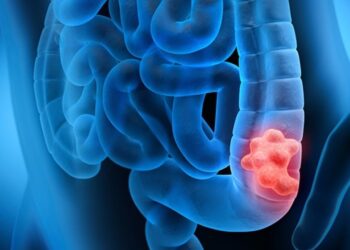 Έρχονται οι προληπτικές διαγνωστικές εξετάσεις για τον καρκίνο του παχέος εντέρου