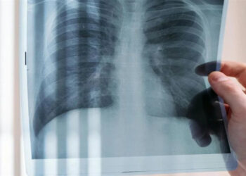 Καρκίνος του πνεύμονα: Νέο πρωτοποριακό φάρμακο σταματά την εξέλιξή του