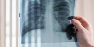 Καρκίνος του πνεύμονα: Νέο πρωτοποριακό φάρμακο σταματά την εξέλιξή του