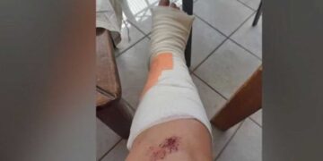 Θεσσαλονίκη: Γυναίκα υπέστη πολλαπλά κατάγματα όταν υποχώρησε το οδόστρωμα - "Άνοιξε ο δρόμος και την κατάπιε" (βίντεο)