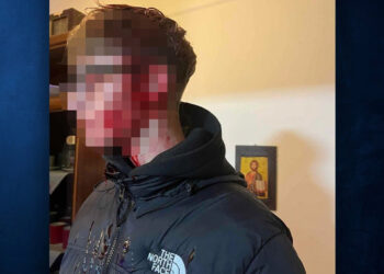 Σοκάρει η φωτογραφία με τα τραύματα του 16χρονου Πτολεμαϊδιώτη μετά από την επίθεση που δέχθηκε από ομάδα ανηλίκων