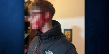 Σοκάρει η φωτογραφία με τα τραύματα του 16χρονου Πτολεμαϊδιώτη μετά από την επίθεση που δέχθηκε από ομάδα ανηλίκων