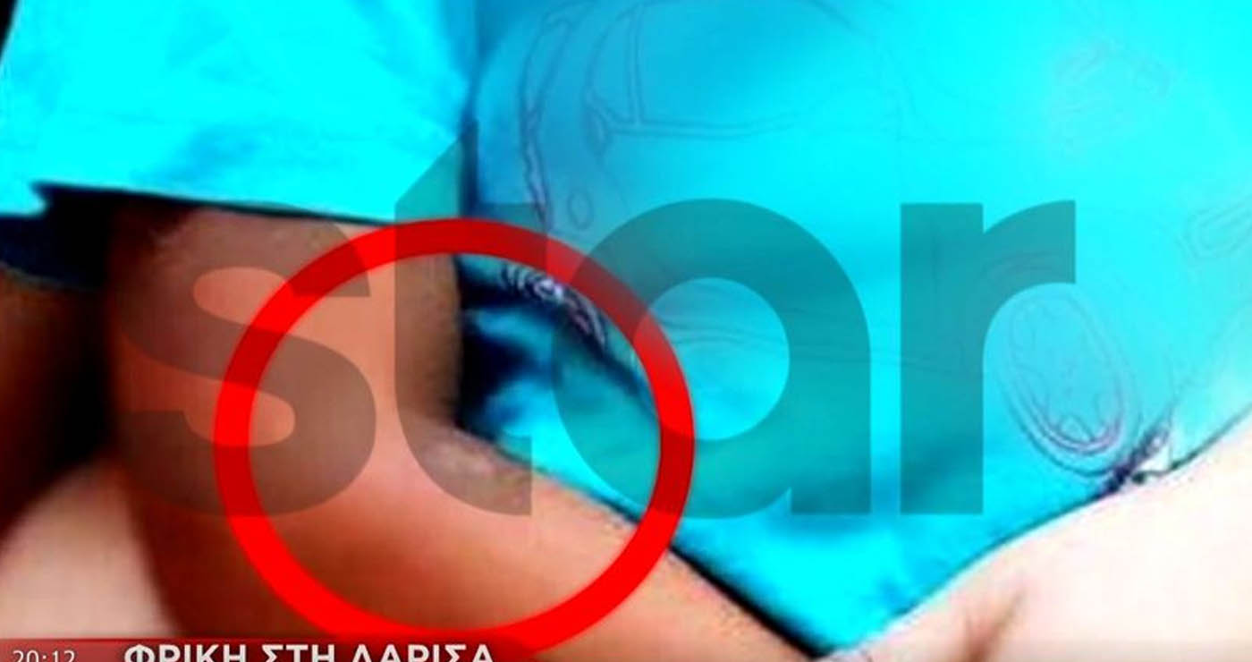 Φρίκη στη Λάρισα: Έσβηνε τσιγάρα πάνω στο κορμί των δύο παιδιών της