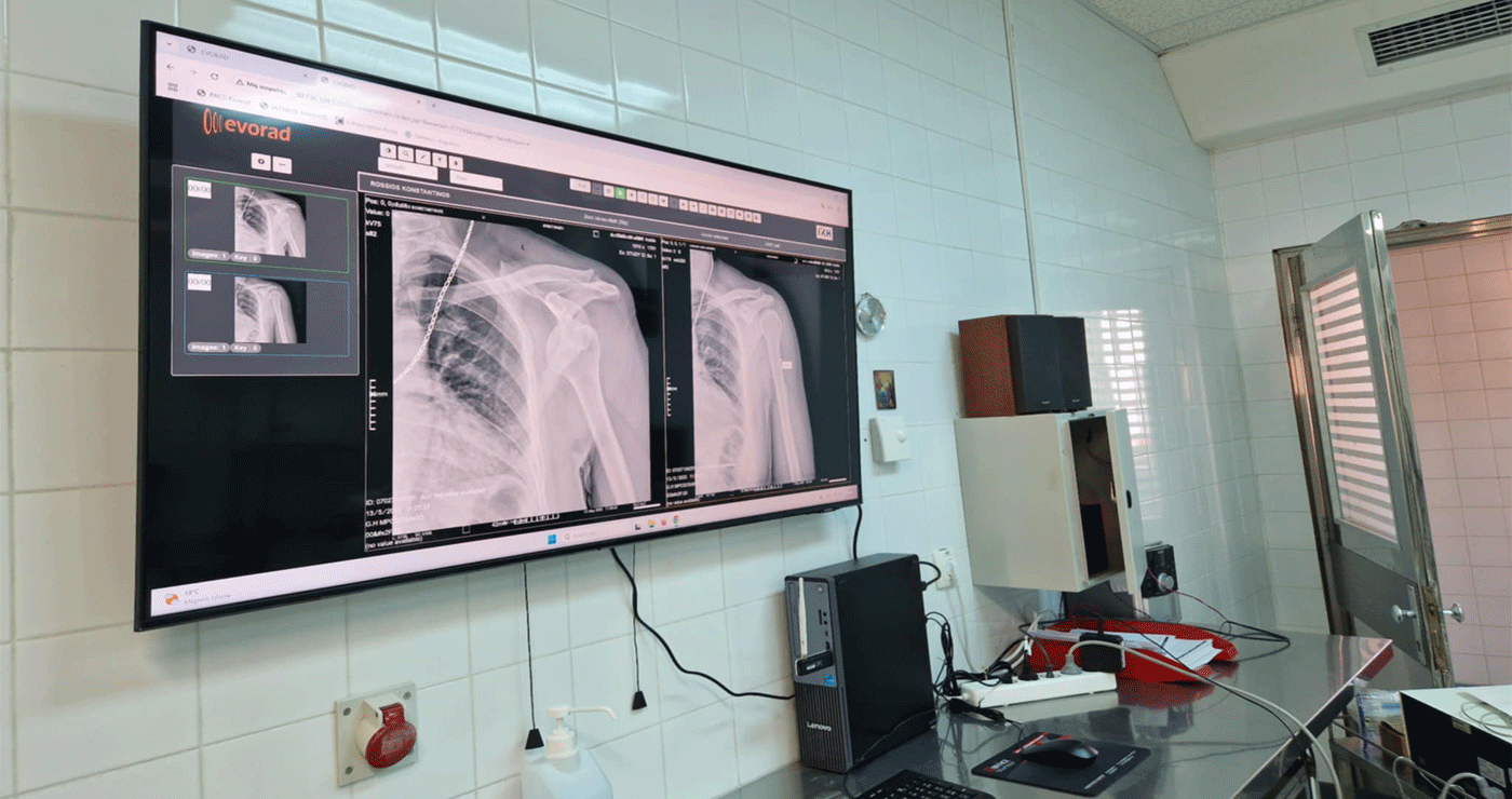 Νέες οθόνες για την προβολή ακτινογραφιών εγκαταστάθηκαν στο Μποδοσάκειο Νοσοκομείο Πτολεμαΐδας