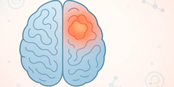 Γλοιοβλάστωμα: Η σημασία της έγκαιρης διάγνωσης