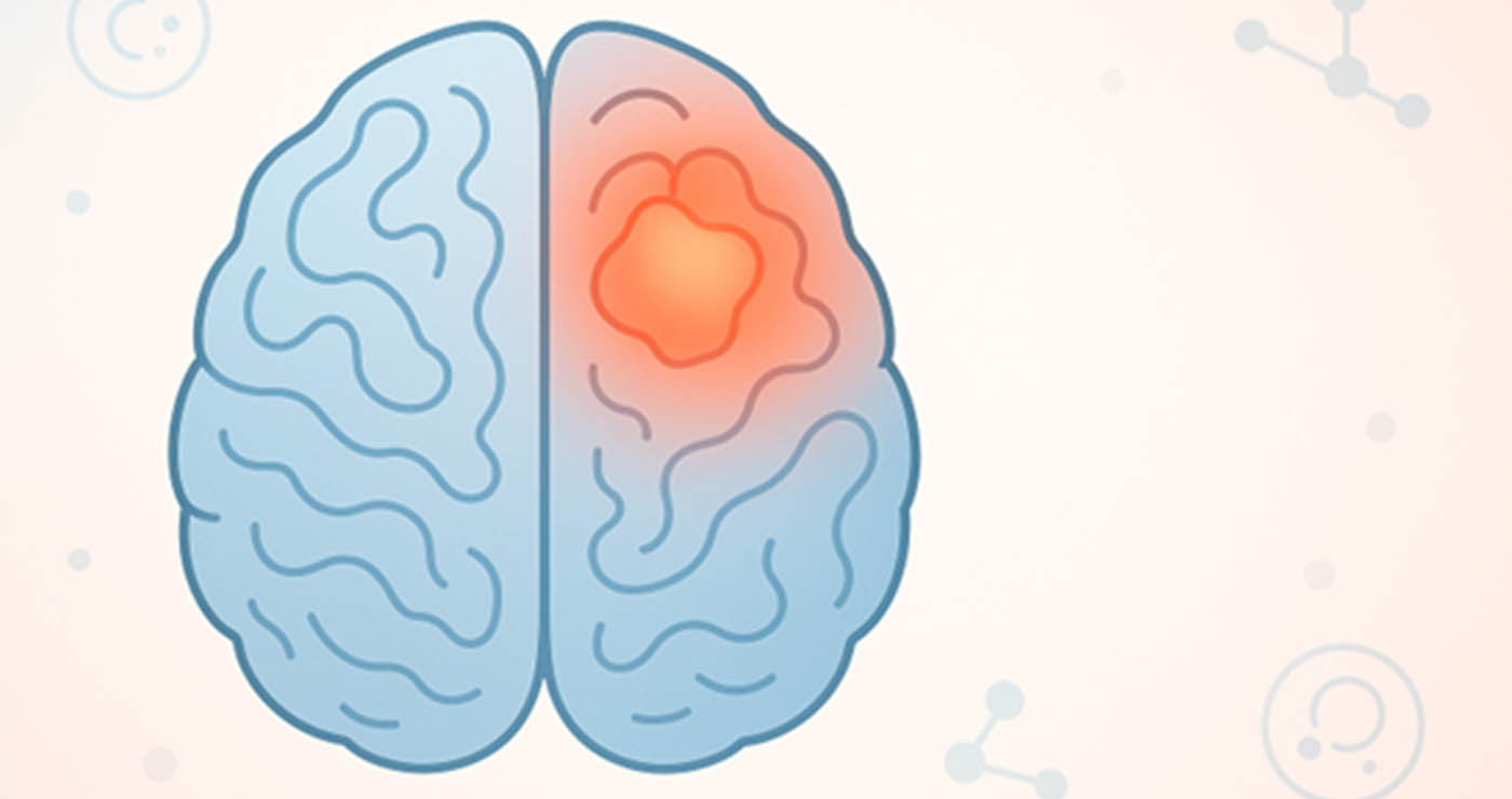 Γλοιοβλάστωμα: Η σημασία της έγκαιρης διάγνωσης