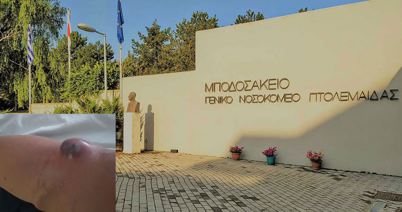 Μποδοσάκειο: Σωτήρια επέμβαση του Ιατρείου Αγγειακών Προσπελάσεων για 48χρονο ασθενή με ρήξη fistulas