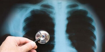 Έκτακτο : Κρούσμα φυματίωσης στην Καστοριά – Που νοσηλεύεται ο ασθενής