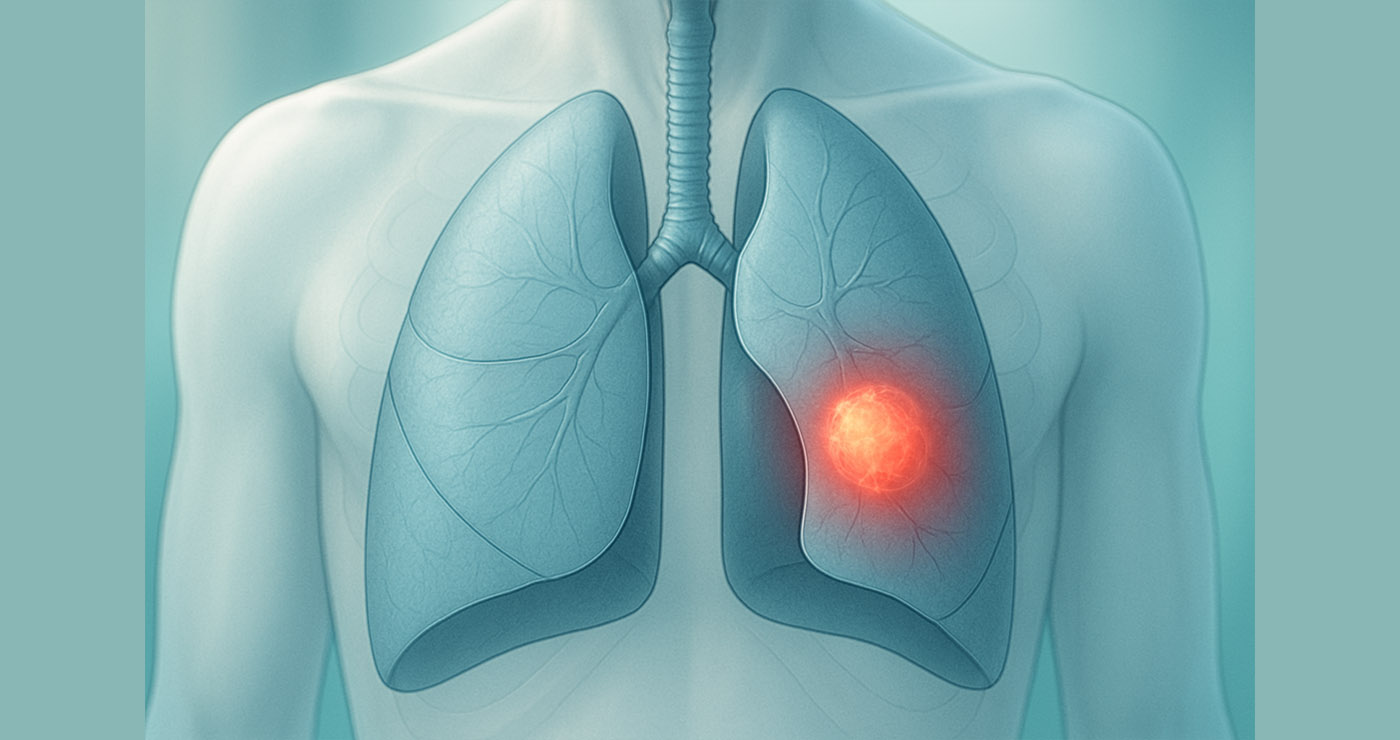 Καρκίνος Πνεύμονα: Όσα Πρέπει να Γνωρίζετε για τη Διάγνωση και τη Σύγχρονη Αντιμετώπιση
