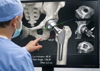MAKO Ρομποτική Αρθροπλαστική Ισχίου: Η Εξέλιξη στην Αντικατάσταση της Άρθρωσης