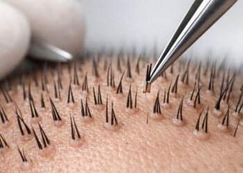 Μεταμόσχευση Μαλλιών: Σύγχρονες Τεχνικές και Αποτελεσματική Αντιμετώπιση της Τριχόπτωσης