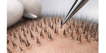 Μεταμόσχευση Μαλλιών: Σύγχρονες Τεχνικές και Αποτελεσματική Αντιμετώπιση της Τριχόπτωσης